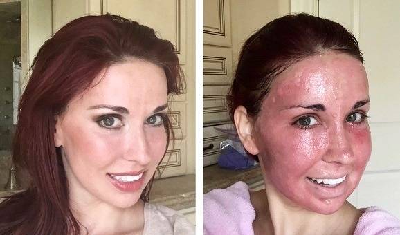 لیزر فرکشنال CO2