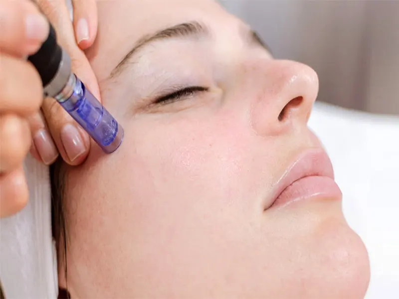 میکرونیدلینگ RF